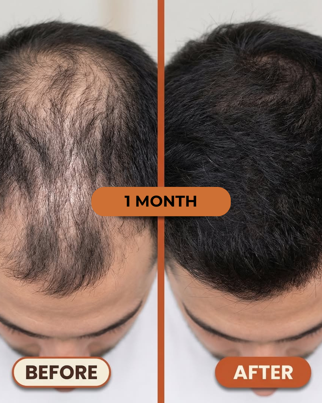 OUHOE - Biotin Hair Growth Serum (100% Result)